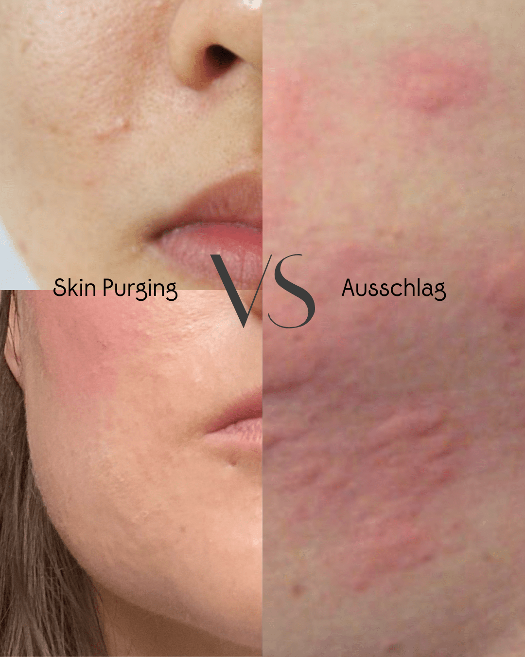 Was du über Skin-Purging wissen solltest - Areum Labs